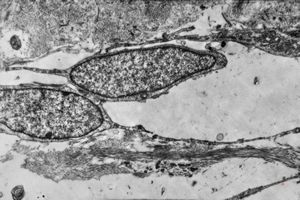 F,42y. | pseudoangiomatous hyperplasia F,42y. | pseudoangiomatous hyperplasia